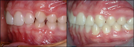 Patient 61 before and after orthodontic Deepbite treatment