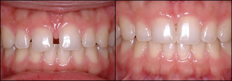 Patient 5 before and after orthodontic treatment