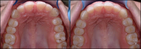 Patient 25 before and after orthodontic treatment