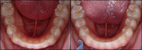 Patient 24 before and after orthodontic treatment