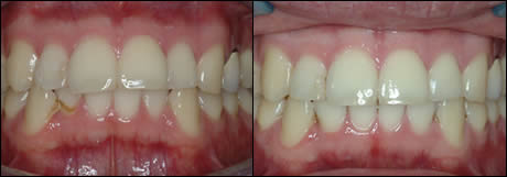 Patient 23 before and after orthodontic treatment