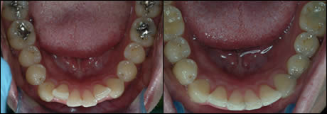 Patient 21 before and after orthodontic treatment