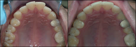 Patient 22 before and after orthodontic treatment
