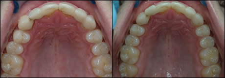 Patient 19 before and after orthodontic treatment