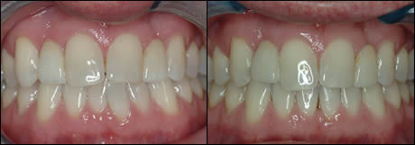 Patient 20 before and after orthodontic treatment