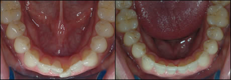 Patient 18 before and after orthodontic treatment