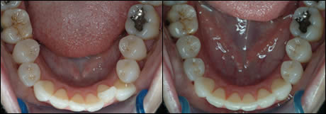 Patient 15 before and after orthodontic treatment