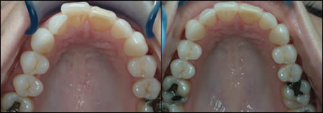 Patient 16 before and after orthodontic treatment