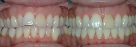 Patient 12 before and after orthodontic treatment