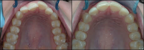 Patient 14 before and after orthodontic treatment