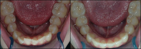 Patient 13 before and after orthodontic treatment