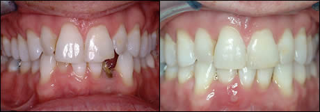 Patient 11 before and after orthodontic treatment