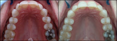 Patient 10 before and after orthodontic treatment