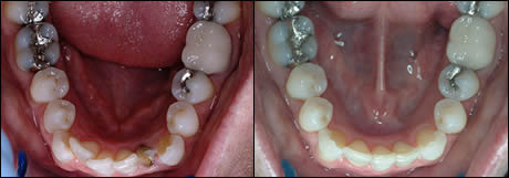 Patient 9 before and after orthodontic treatment