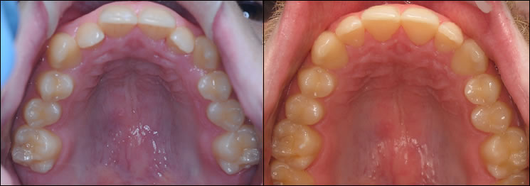 Patient 30 before and after orthodontic Invisalign treatment