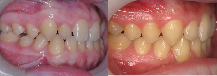 Patient 32 before and after orthodontic Invisalign treatment