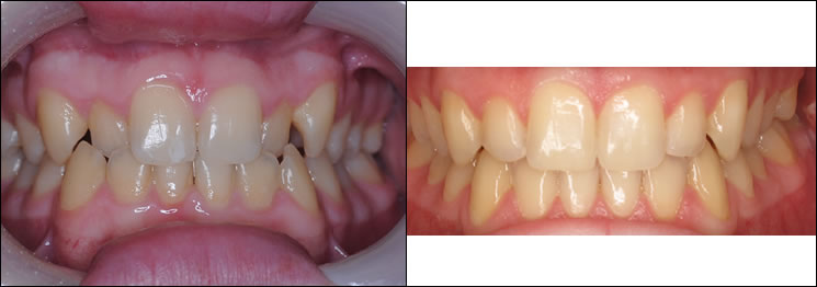 Patient 33 before and after orthodontic Invisalign treatment