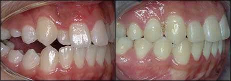 Patient 49 before and after orthodontic surgical treatment