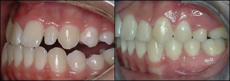 Patient 50 before and after orthodontic Openbite treatment