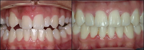 Patient 3 before and after orthodontic treatment