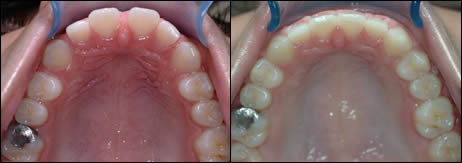 Patient 65 before and after orthodontic Spacing treatment