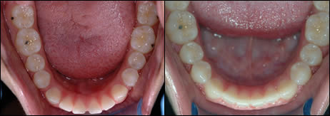 Patient 64 before and after orthodontic Spacing treatment