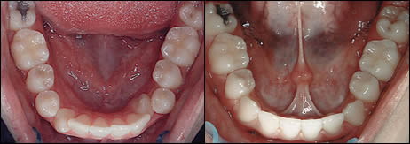 Patient 41 before and after orthodontic surgical treatment