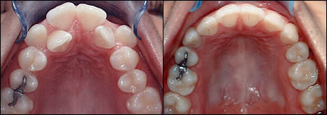 Patient 7 before and after orthodontic treatment