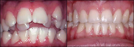 Patient 2 before and after orthodontic treatment