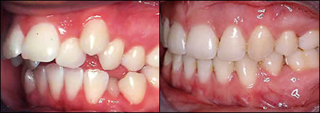 Patient 40 before and after orthodontic surgical treatment
