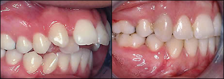Patient 39 before and after orthodontic surgical treatment