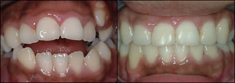 Patient 6 before and after orthodontic treatment