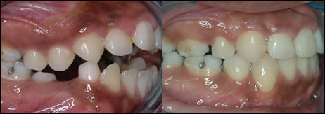 Patient 37 before and after orthodontic surgical treatment