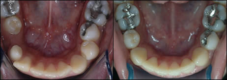 Patient 36 before and after orthodontic surgical treatment