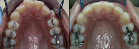 Patient 35 before and after orthodontic surgical treatment