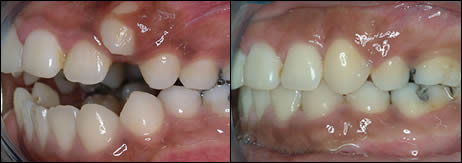 Patient 4 before and after orthodontic treatment