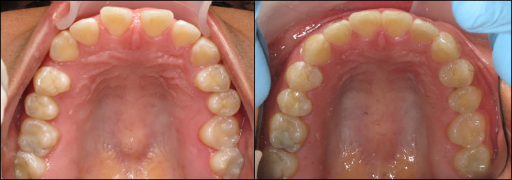 Patient 46 before and after orthodontic surgical treatment