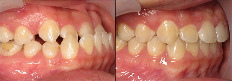 Patient 45 before and after orthodontic surgical treatment