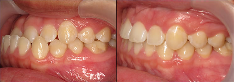 Patient 47 before and after orthodontic surgical treatment