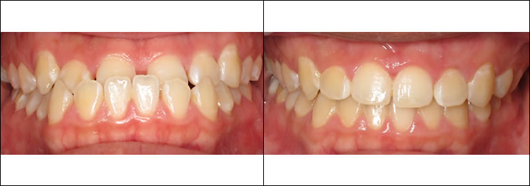 Patient 48 before and after orthodontic surgical treatment