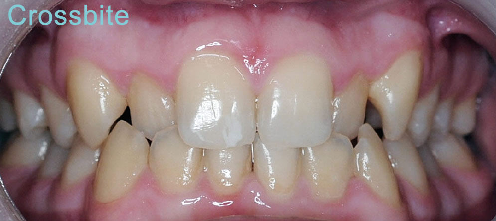 Patient 6 - Teeth with Crossbite close up before orthodontic treatment