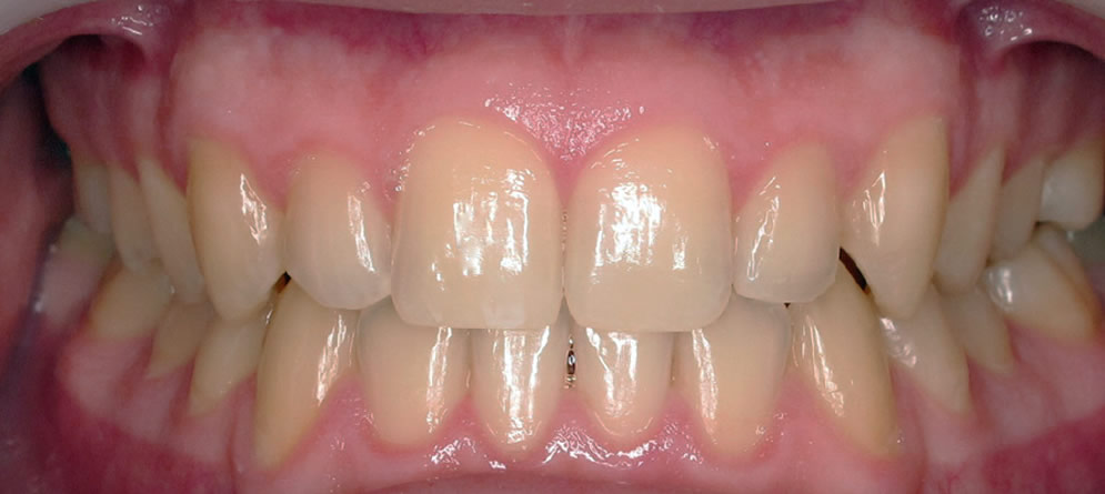 Patient 6 - Teeth with Crossbite close up after orthodontic treatment