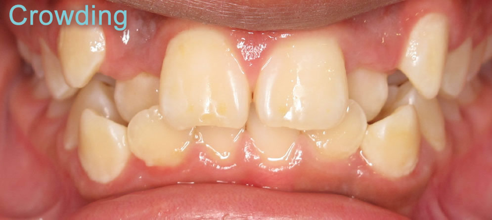 Patient 5 - Teeth with Crowding close up before orthodontic treatment