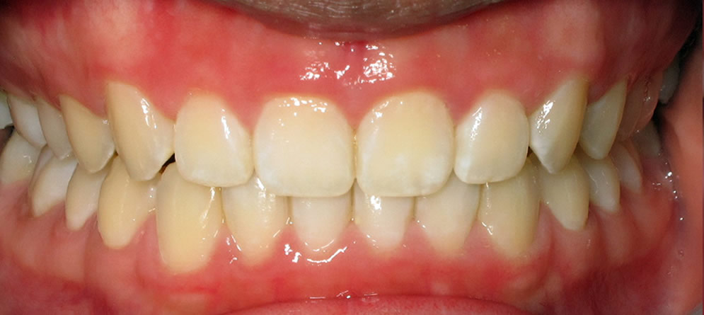 Patient 4 - Teeth with Deep Bite close up after orthodontic treatment