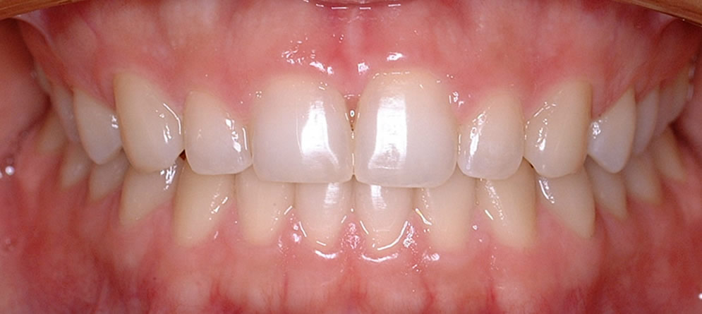 Patient 3 - Teeth close up after orthodontic treatment