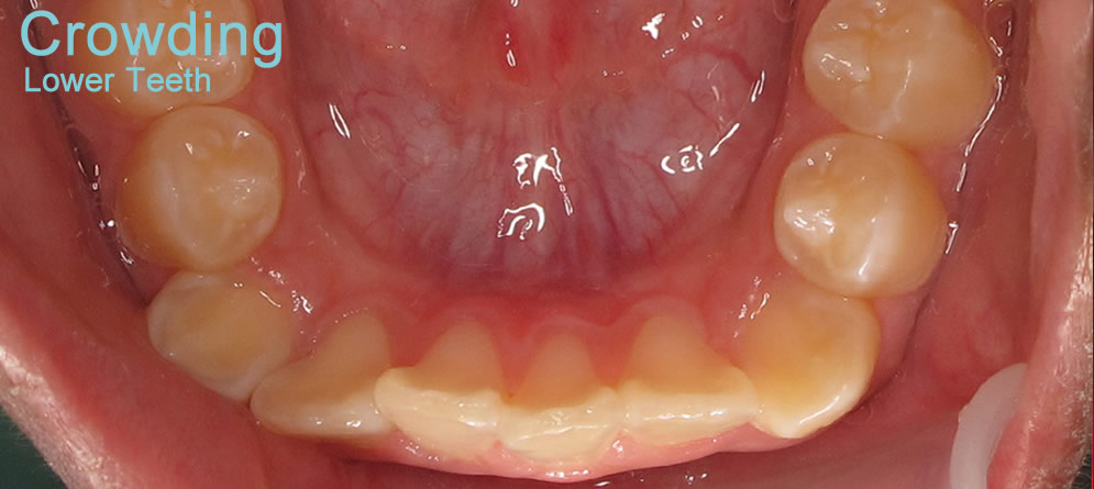 Patient 2 - Teeth close up crowding lower teeth before orthodontic treatment