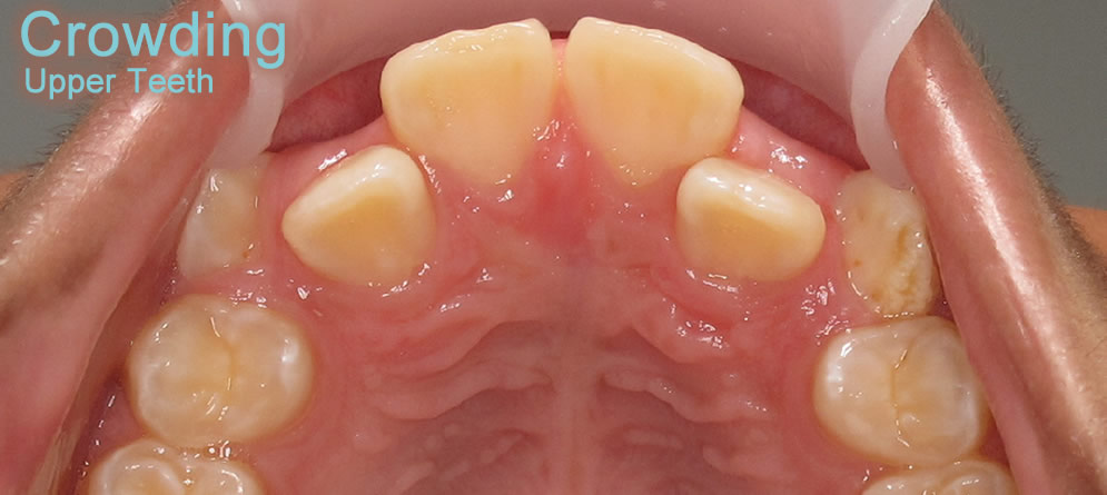 Patient 1 - Teeth close up crowding upper teeth before orthodontic treatment