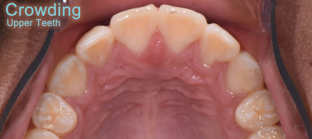 Patient 1 - Teeth close up crowding upper teeth after orthodontic treatment